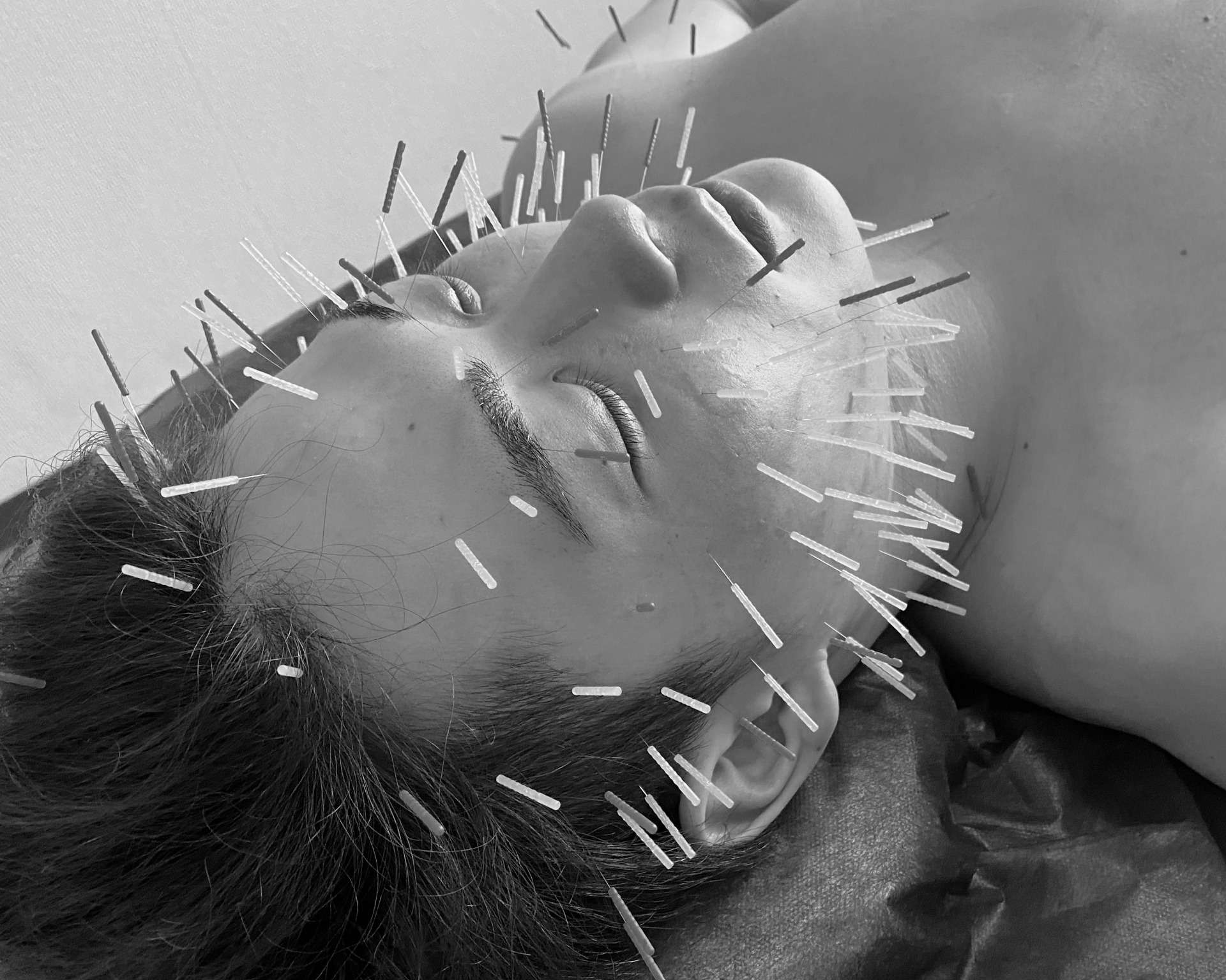 Structural Beauty (構造美容鍼・小顔・噛み合わせ)